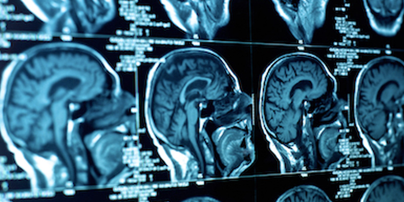 diagnosis brain spine tumors