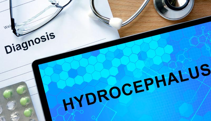 Hydrocephalus – A Shunting Alternative Treatment for Hydrocephalus | Advanced Neurosurgery Associates