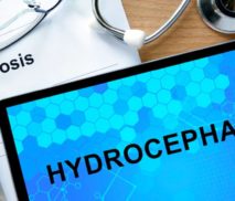 hydrocephalus alternative treatment without shunt