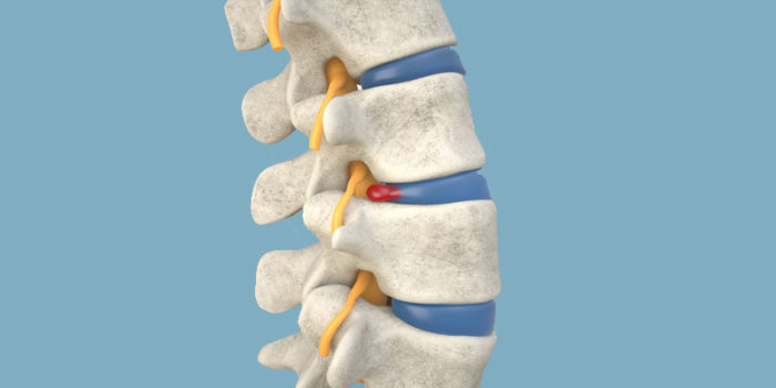 Herniated Disc Treatment: When to Get Surgery | Advanced Neurosurgery